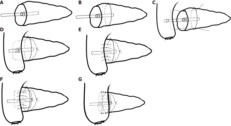Binding and interlocking pancreaticojejunostomy <i>vs</i> duct to mucosa pancreaticojejunostomy: A retrospective cohort study.
