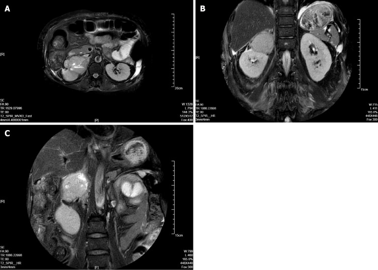 Pheochromocytoma presenting with vomiting and heart failure: A case report.