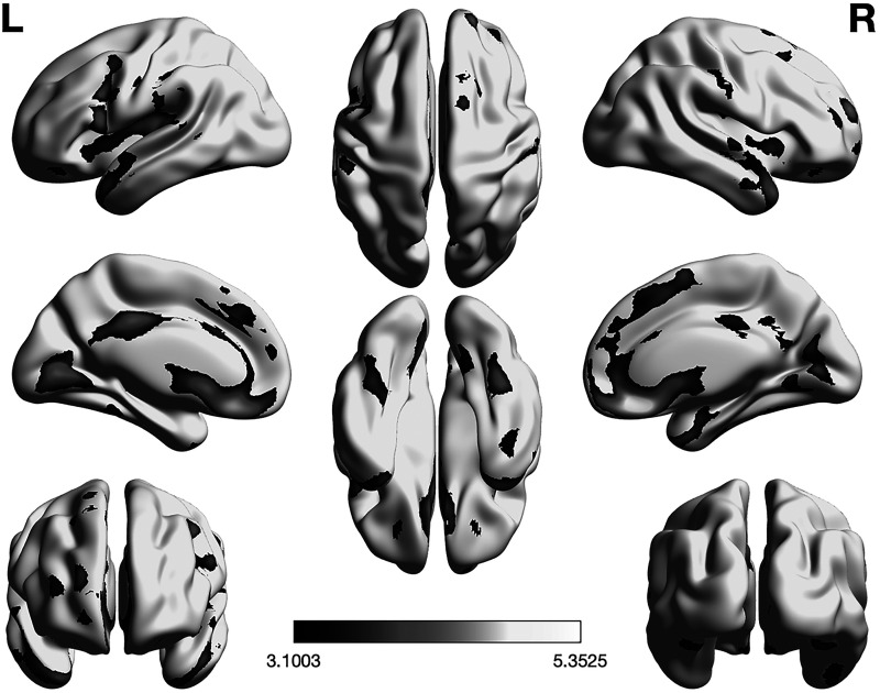 The expression of insulin signaling and N-methyl-D-aspartate receptor genes in areas of gray matter atrophy is associated with cognitive function in type 2 diabetes.