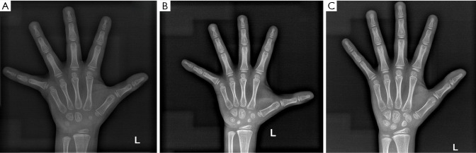 Noonan syndrome with <i>PTPN11</i> gene variant presenting as isolated short stature: a case report.