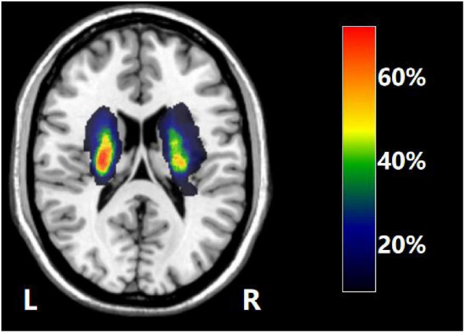 Altered brain dynamics in post-stroke cognitive and motor dysfunction.