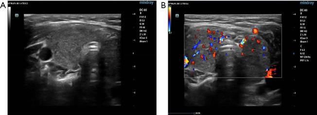 A case report of Graves' disease combined with pseudohypoaldosteronism type IID in a child.