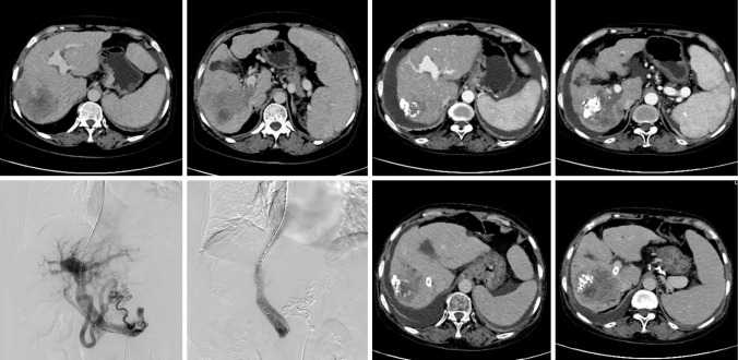 Clinical significance of transjugular intrahepatic portosystemic shunting for hepatocellular carcinoma complicated with portal hypertension.