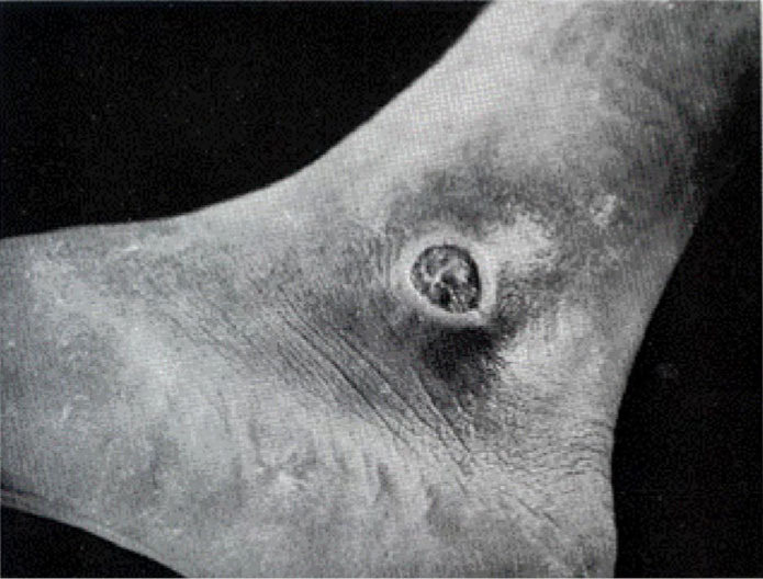 Early U.S. military immunization against tetanus and diphtheria: historical context and current importance.