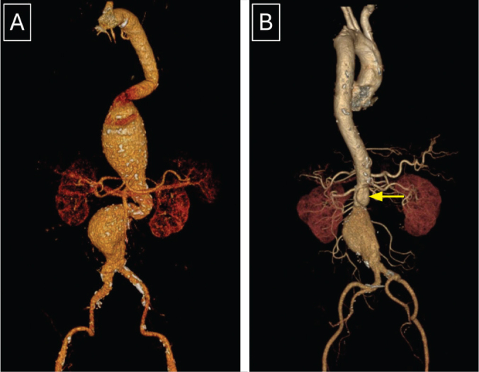 Hybrid Repair for Complex Thoracoabdominal and Pararenal Aortic Aneurysms in High-Risk Patients: A Case Series.