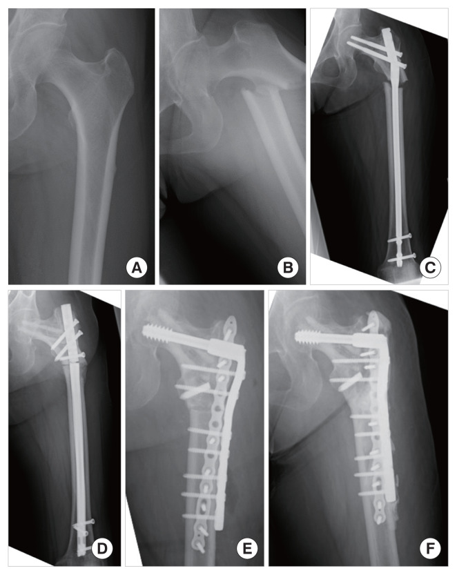 Pitfalls in the Missed Diagnosis of Atypical Femoral Fracture Presenting as Prodromal Pain that Mimics Degenerative Disease: A Multicenter Study - Secondary Publication of the Japanese Version.