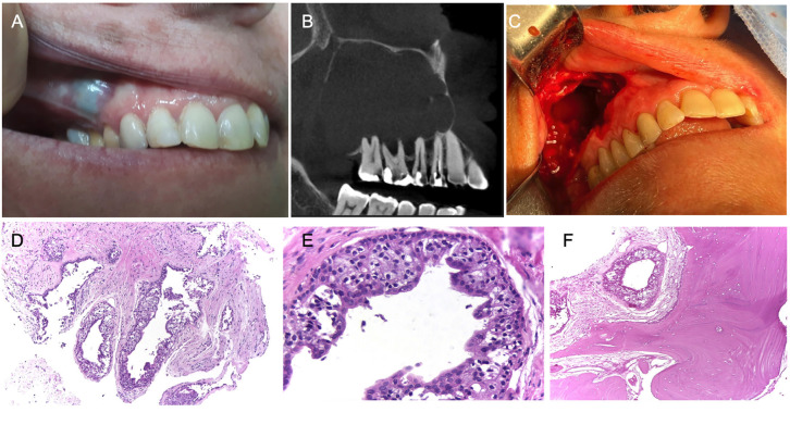Maxillary Glandular Odontogenic Cyst - report of 3 cases and literature review.
