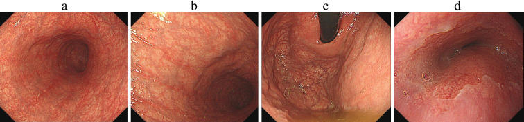 Rapid Development of a Hemorrhagic Hyperplastic Polyp in a Patient with Evolving Autoimmune Gastritis after Helicobacter pylori Eradication.