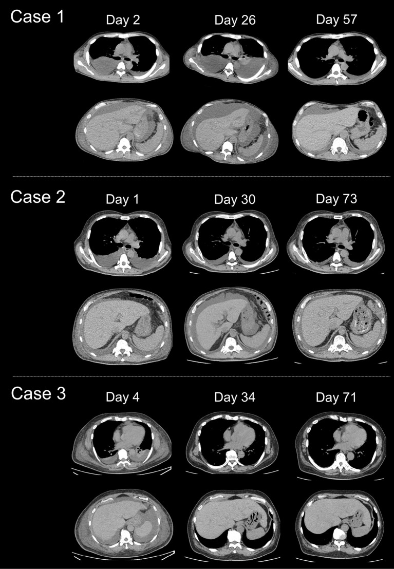 Serum Soluble Interleukin-2 Receptor as a Potential Marker for Assessing Disease Activity in the TAFRO Subtype of Idiopathic Multicentric Castleman Disease.