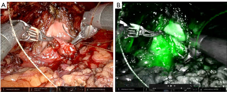 A review of management options for vesicourethral anastomotic stenosis and the emergence of robotic reconstruction.