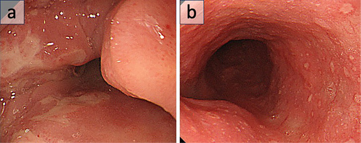 Laryngeal Web Caused by Mucous Membrane Pemphigoid.