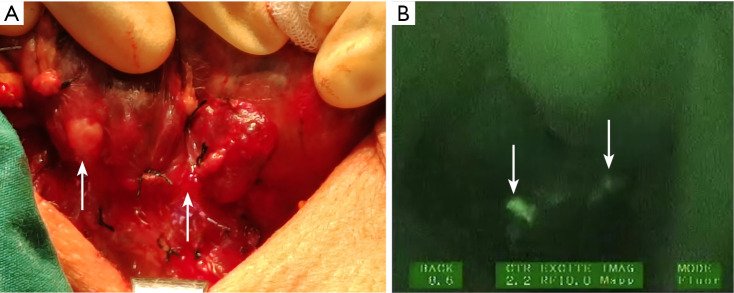 Evaluation of the effectiveness of near-infrared autofluorescence (NIRAF) imaging combined with immunocolloidal gold technique (ICGT) in identifying and protecting parathyroid glands during thyroid cancer surgery.