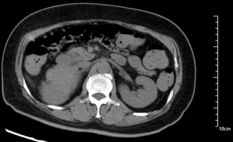 Pheochromocytoma presenting with vomiting and heart failure: A case report.