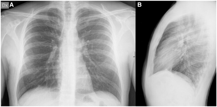 Cardiac magnetic resonance as the key to uncovering unusual disseminated histoplasmosis: a case report.