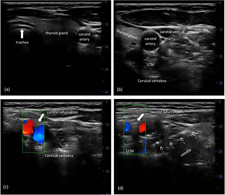 Ultrasound-guided block of the superior cervical ganglion for migraine attacks: a propensity score-matched retrospective study.