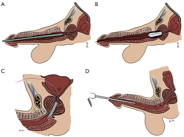 Endoscopic buccal urethroplasty for membranous stricture disease.