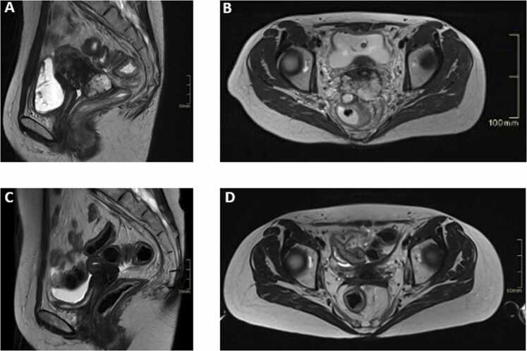 Long-Term Tumor Control After Carbon Ion Radiation Therapy Boost in Locally Advanced Cervical Clear Cell Adenocarcinoma.