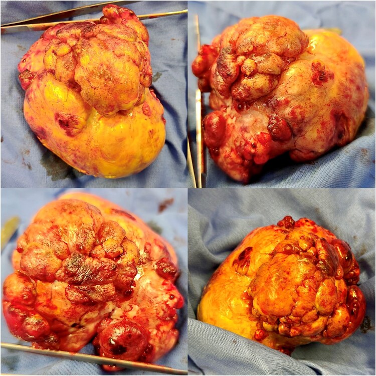 Intrapericardial localization of solitary fibrous tumour: a case report.