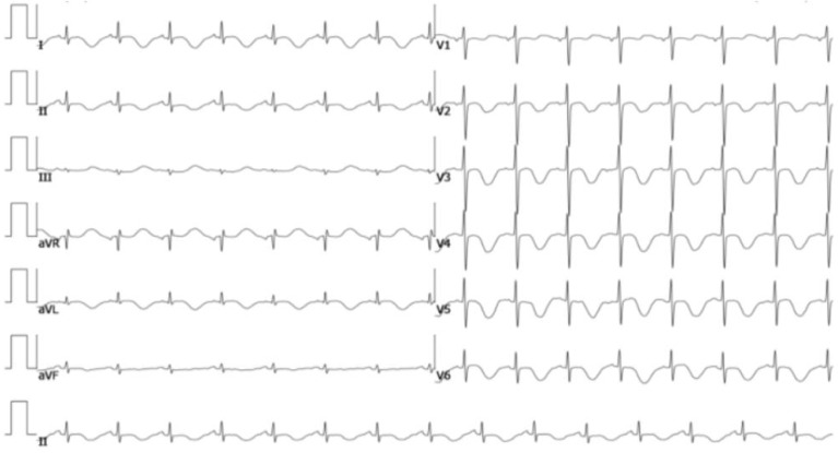 Pheochromocytoma presenting with vomiting and heart failure: A case report.