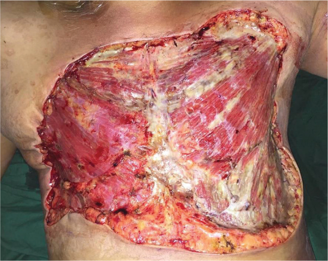 Necrotizing Fasciitis of Bilateral Breasts following Unilateral Modified Radical Mastectomy for Invasive Ductal Carcinoma: A Case Report and Review of Literature.