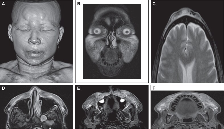 Severe Complications Due to Biopolymers in a Patient With Autoimmune Disease: A Case Report and Review of the Literature.