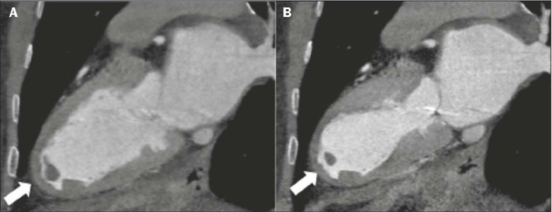 The spectrum of imaging findings in takotsubo cardiomyopathy: a pictorial essay.
