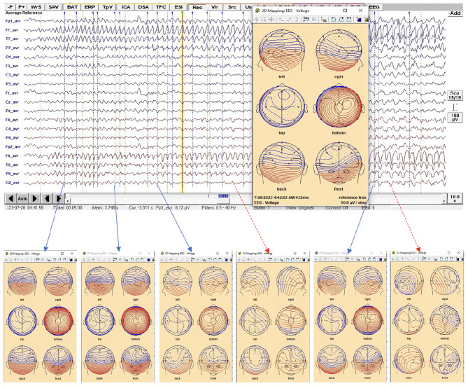 Epileptic brain imaging by source localization CLARA supported by ictal-based semiology and VEEG in resource-limited settings.