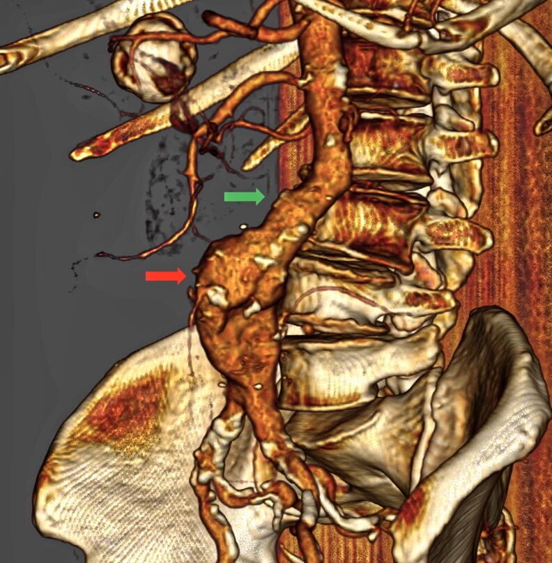 Aorta unveiled: the crucial role of imaging in diagnosing and managing aortic disease-a review.