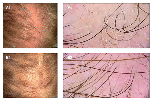 Skin infection by larva migrans and scabies mites: case reports on unusual skin localizations.