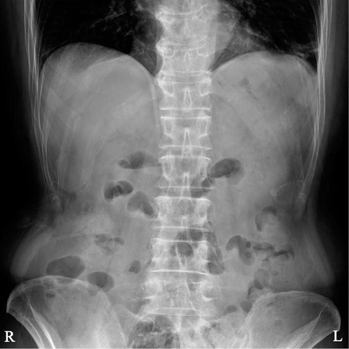 Paralytic Ileus Following Long-term Erenumab Treatment.