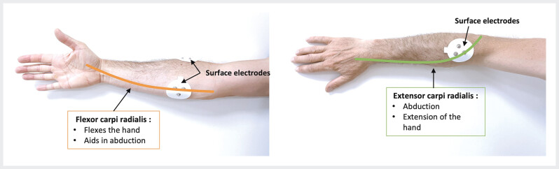 Characterization of biomechanical risk factors during endoscopic submucosal dissection: Ergonomic pilot study.