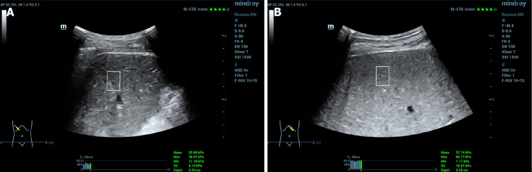 Changes in liver and spleen stiffness after transjugular intrahepatic portosystemic shunt and their relationship with prognosis.