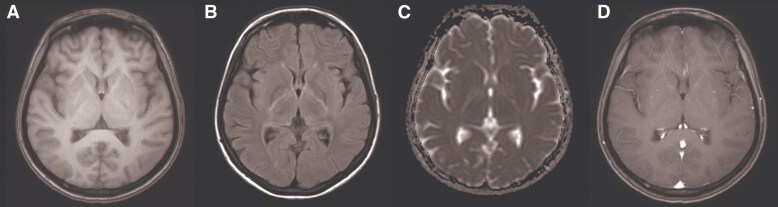 Opsoclonus-myoclonus-ataxia Syndrome in an ART-naïve Patient With CSF/Plasma HIV-1 RNA Discordance.
