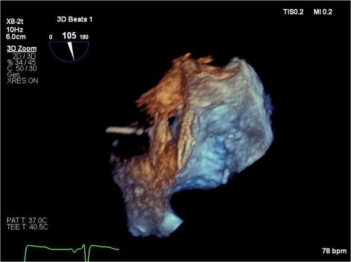 Platypnoea-orthodeoxia syndrome following transcatheter aortic valve implantation complicated by aortic annular rupture: a case report.