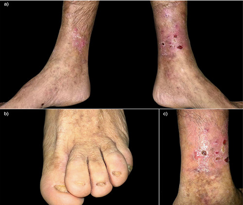 Localized variant of junctional epidermolysis bullosa with R795X mutation.