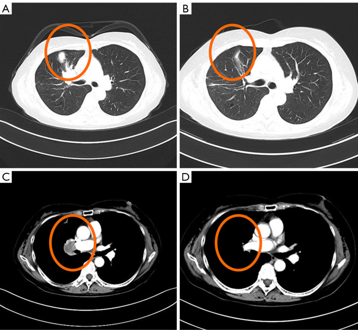 Long-term survival with adaptive dual-targeted therapy in an epidermal growth factor receptor (<i>EGFR</i>)-mutant non-small cell lung cancer patient with mesenchymal-epithelial transition (<i>MET</i>) amplification guided by minimal residual disease (MRD) assessments: a case report and literature review.