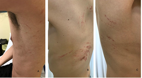 Purpuric pityriasis rosea in patients with anorexia nervosa.
