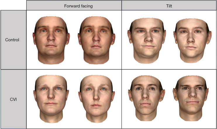 Impaired face identity discrimination in individuals with cerebral visual impairment: a pilot study.