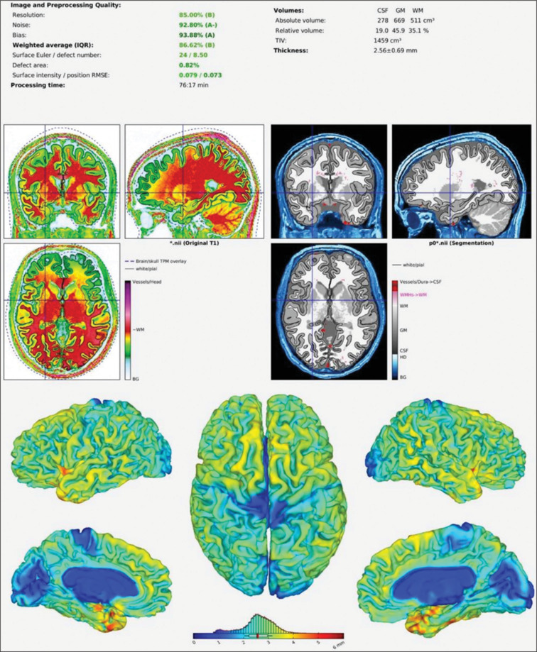 Impact of physical activity and body mass index on brain structure: A cross-sectional MRI study.