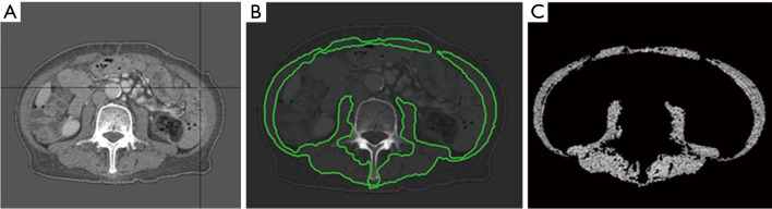 Sarcopenia following concurrent chemoradiotherapy for locally advanced esophageal squamous cell carcinoma.