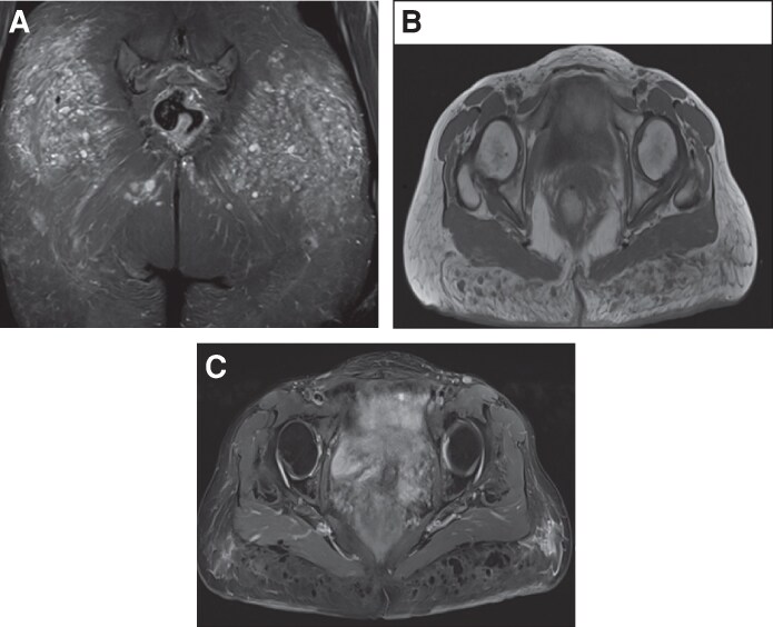 Severe Complications Due to Biopolymers in a Patient With Autoimmune Disease: A Case Report and Review of the Literature.