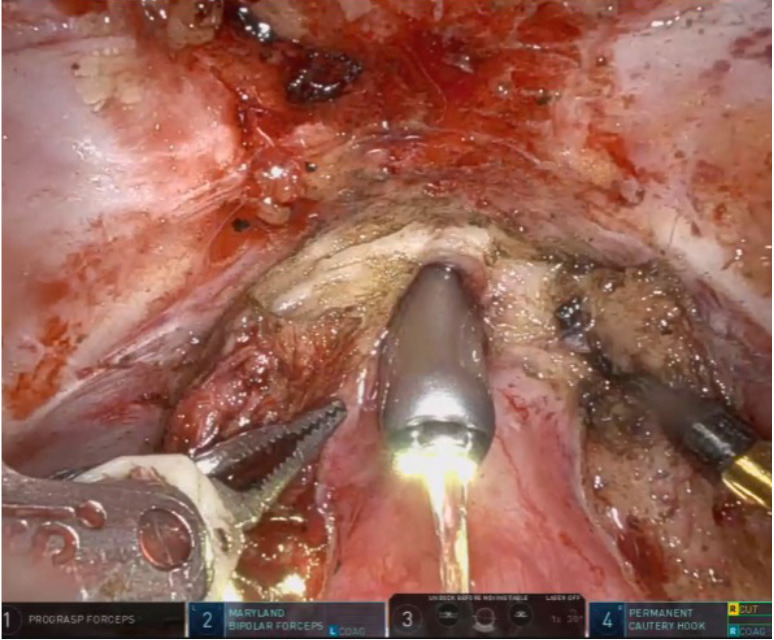 A review of management options for vesicourethral anastomotic stenosis and the emergence of robotic reconstruction.