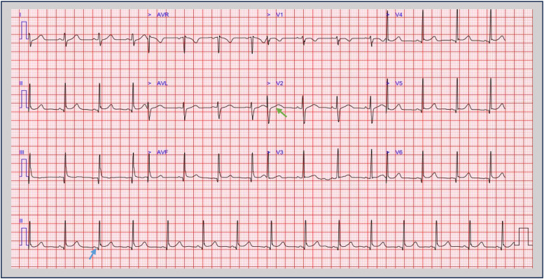 From gut to heart: Salmonella gastroenteritis complicated by myocarditis: a case report.
