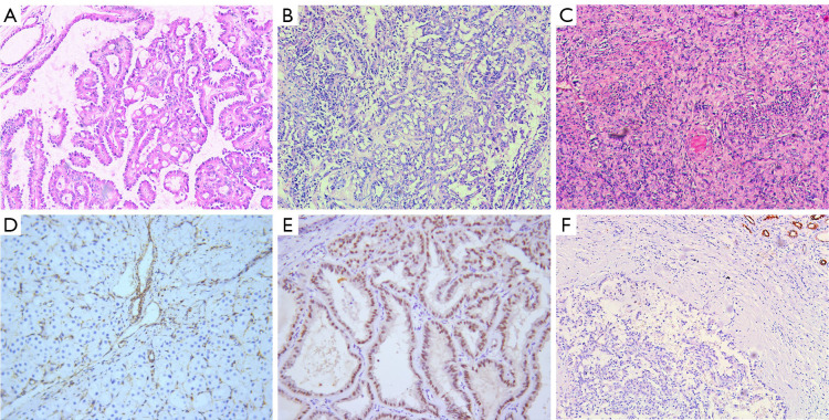 Comparative analysis of clinicopathological characteristics and prognostic outcomes in fumarate hydratase-deficient renal cell carcinoma versus high-grade papillary renal cell carcinoma.