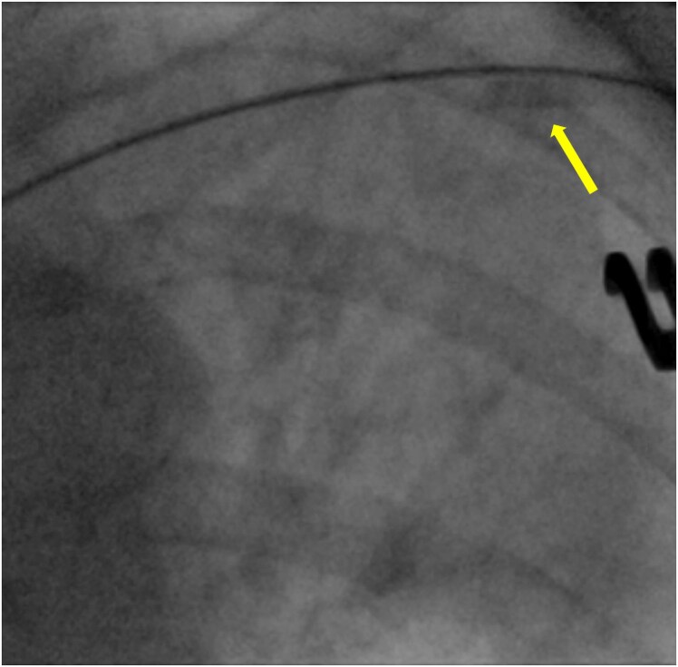 Permanent pacemaker implantation complicated by anchoring sleeve embolization through cephalic vein: case report and discussion of management strategies.