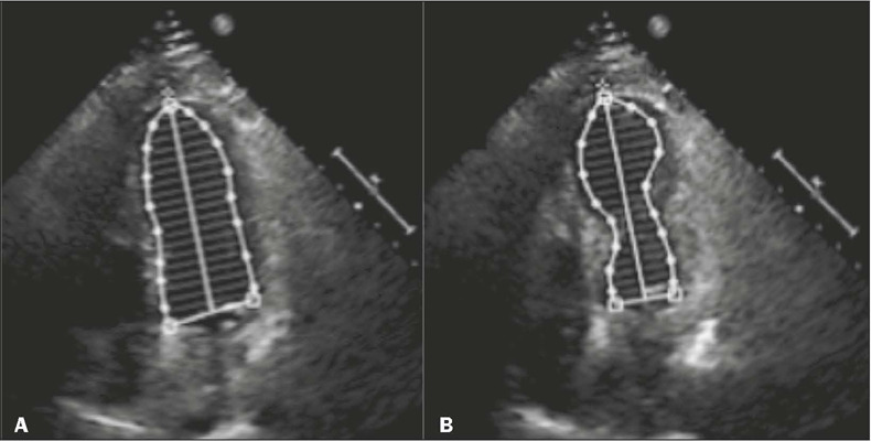 The spectrum of imaging findings in takotsubo cardiomyopathy: a pictorial essay.