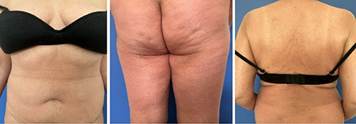Refractory pityriasis rubra pilaris treated with abrocitinib.