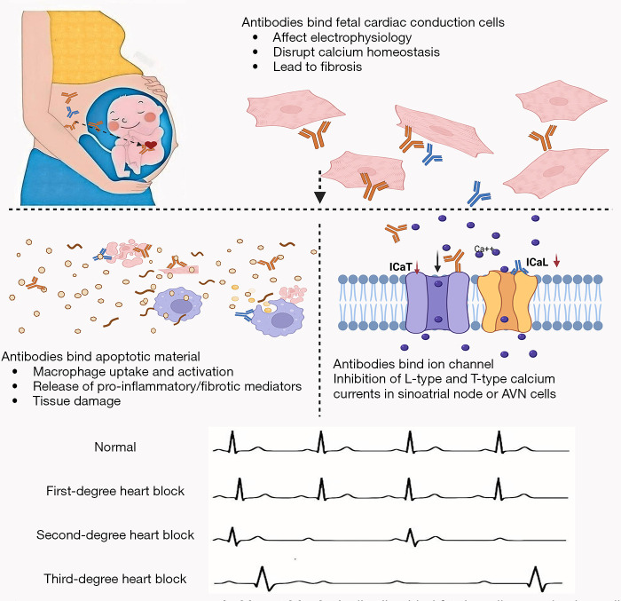 Autoimmune antibodies in arrhythmia: a narrative review of potential therapeutic targets to prevent overtreatment.