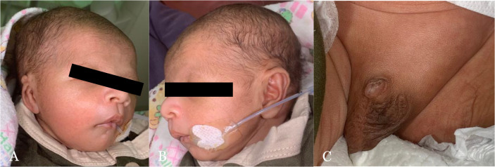 Customized feeding plate for nutritional and respiratory support in an infant with Pierre Robin sequence and cleft palate complicated by severe respiratory infections: A case report.