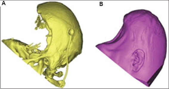 A customized large single-piece bifrontal implant for post-craniectomy defect reconstruction: A case study.